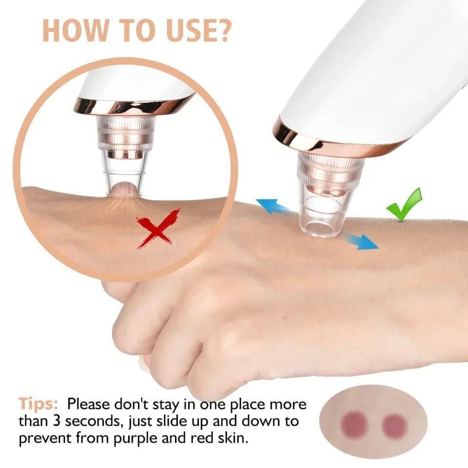 Blackhead Remover Tool – Clear Skin Pore Extractor for Impurity Remove